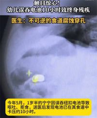 幼兒誤吞電池10小時致終身殘疾 1歲半幼兒吞紐扣電池致殘